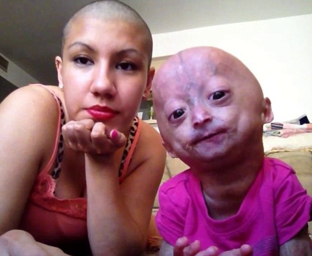 adalia rose the six year old girl with body of an old woman due