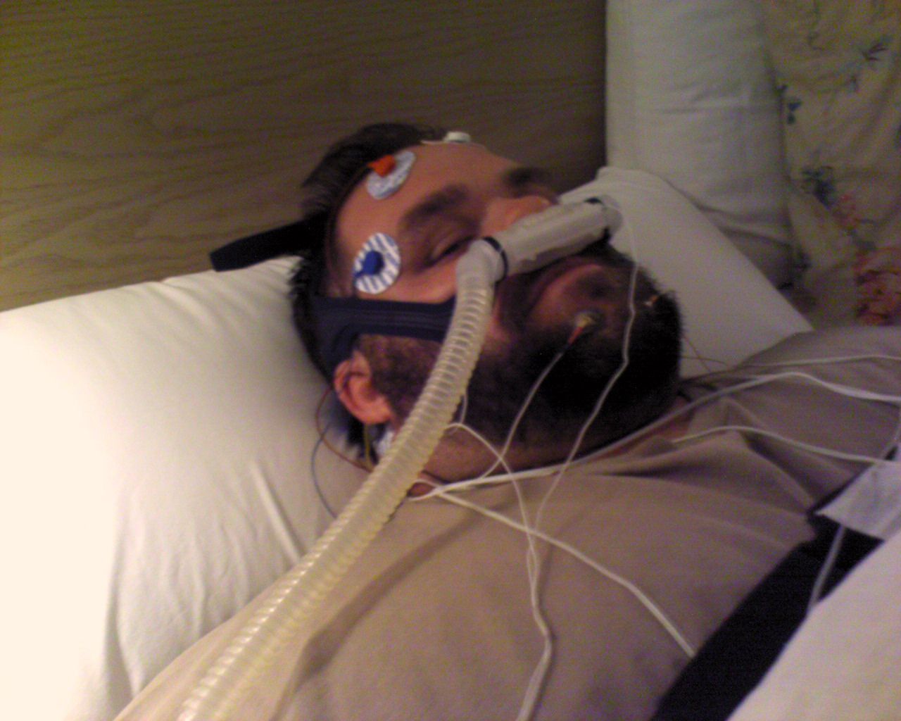 can pacemakers cure obstructive sleep apnea respiratory tract