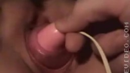 cervix prolapse porn videos 1
