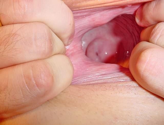 Lesbian Licking Cervix - cervix speculum porn cervix with speculum fetish porn pic fetish porn pic -  MegaPornX