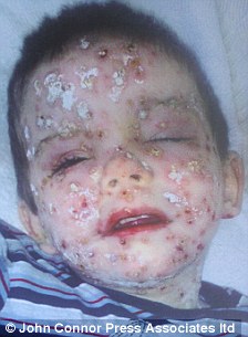 chickenpox killed our son how a little boy died just three weeks 1
