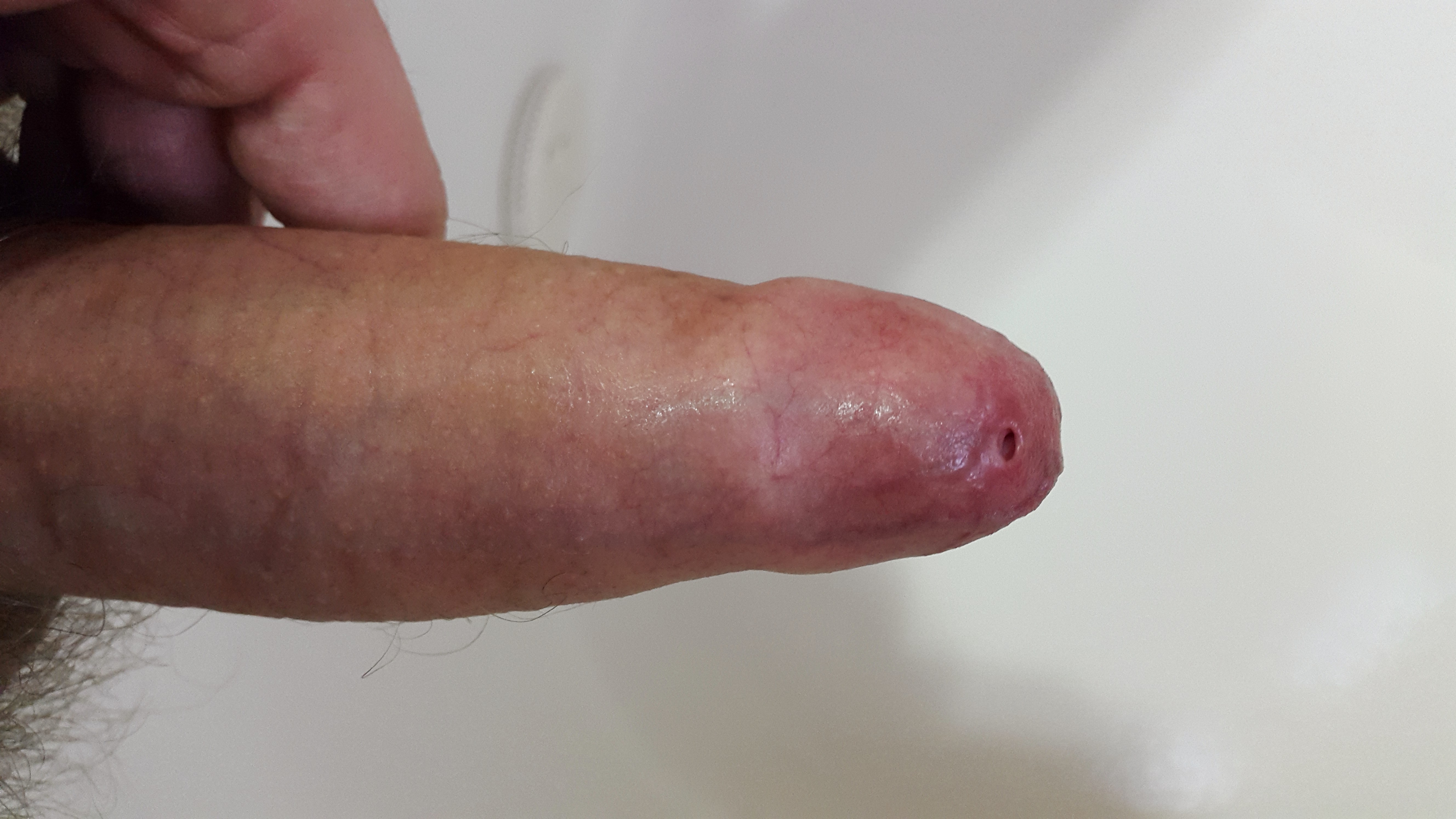 erect penis with severe phimosis tight foreskin