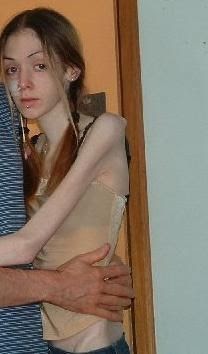 horrors of anorexia damn cool pictures 1