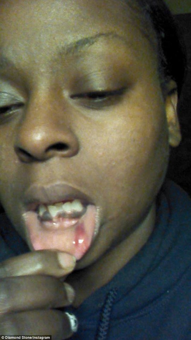 injury diamond showed her bloody bottom lip after her mother claimed she hit her accidentally