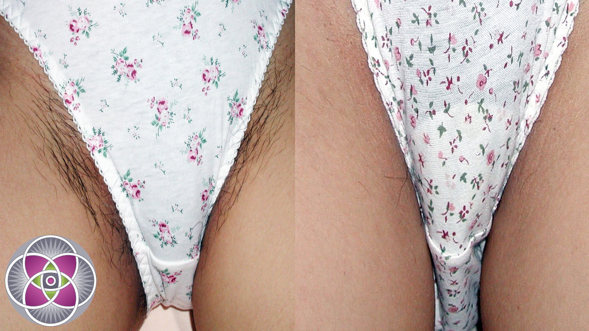 laser hair removal before and after youtube