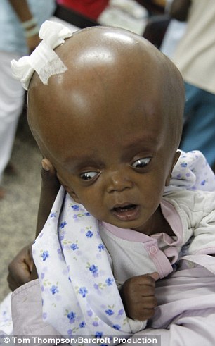 little girl whose head was three times bigger than normal receives