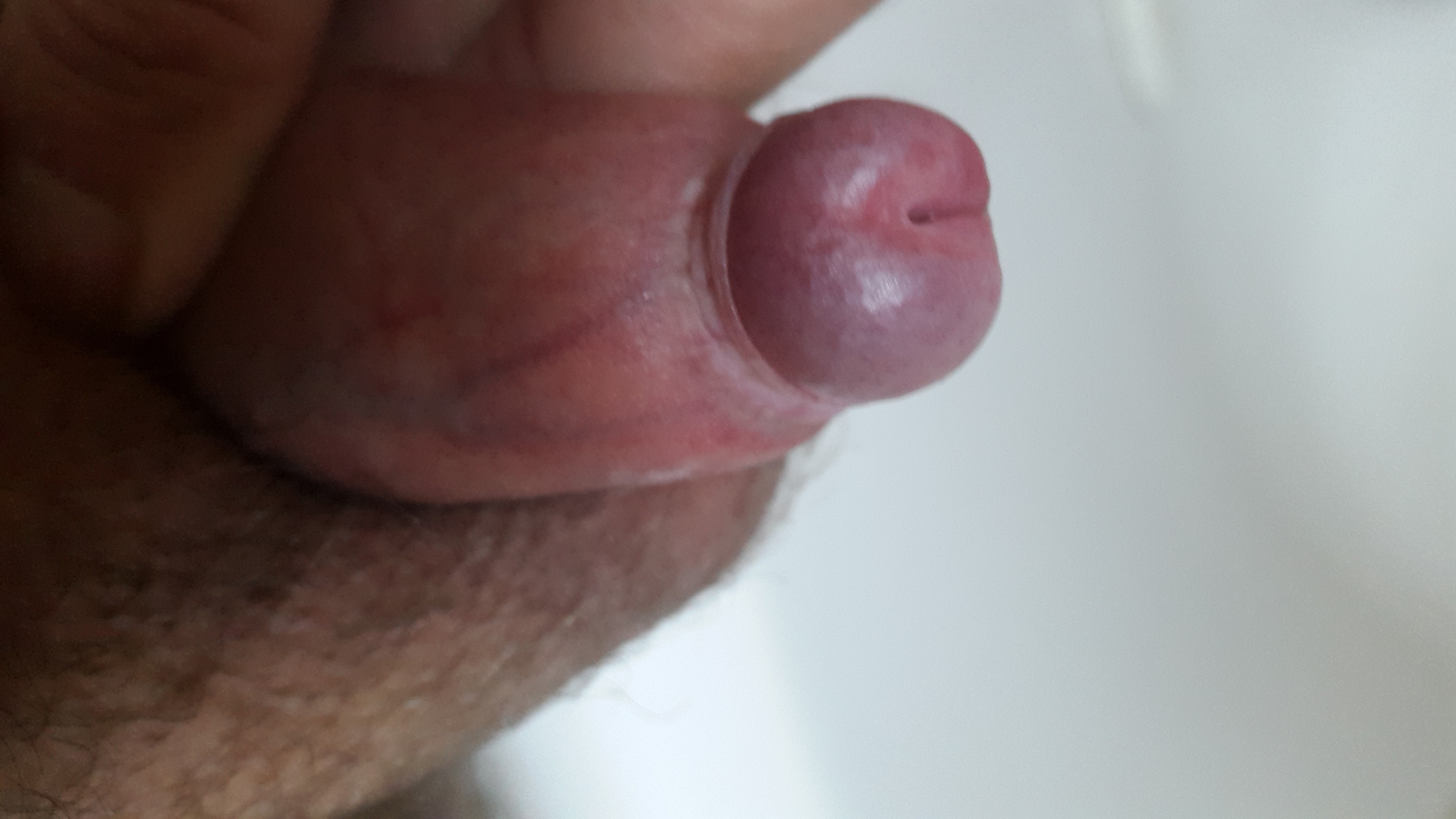 pictures of penis a phimosis journey 1
