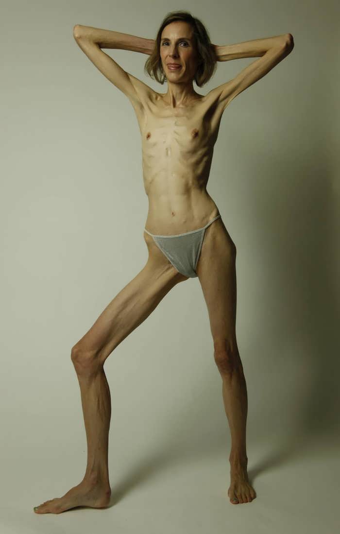 Anorexic College Nude Pics