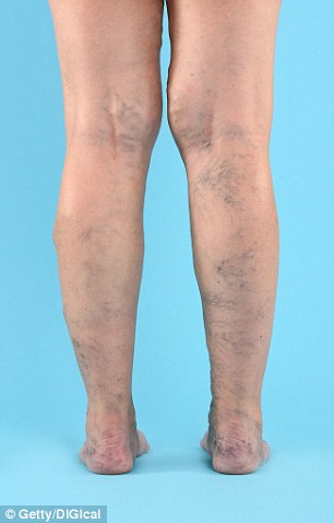 varicose veins typically affect the lower legs but world renowned expert professor mark whiteley reveals